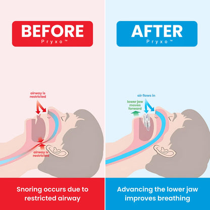 Pryxo Anti-Snoring Device